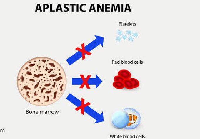 Aplastic Anemia and its causes