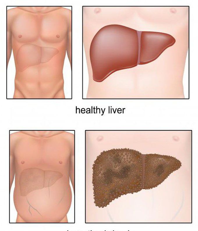 Cause of Caput medusae