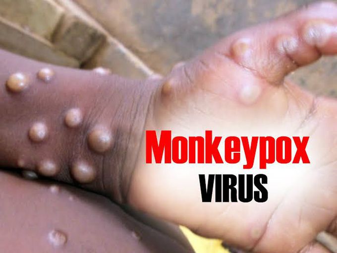 Monkey pox