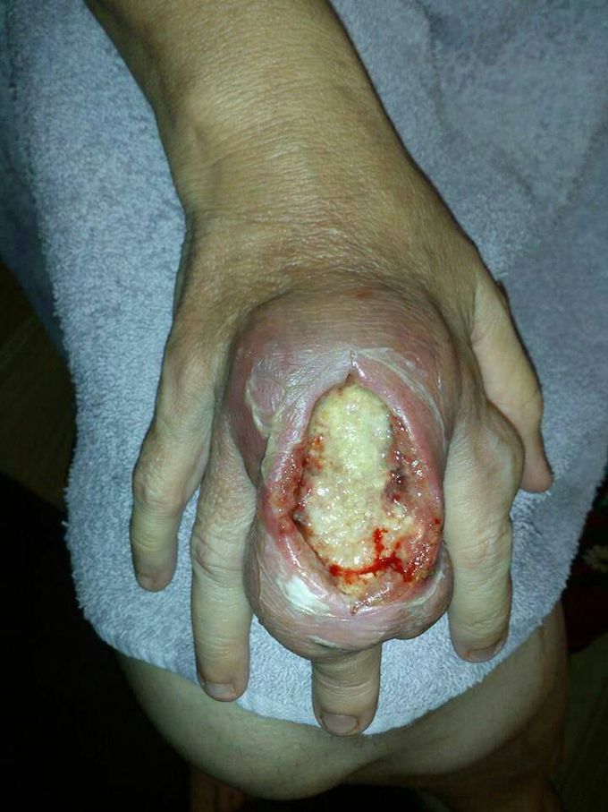 Brown Recluse spider bite after 10 days.