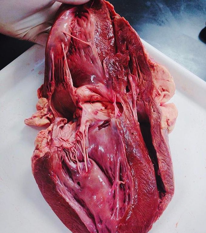 Dissected heart