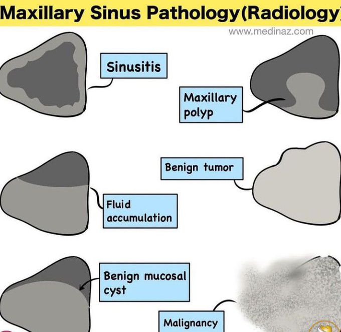 Maxillary Sinus Pathologies