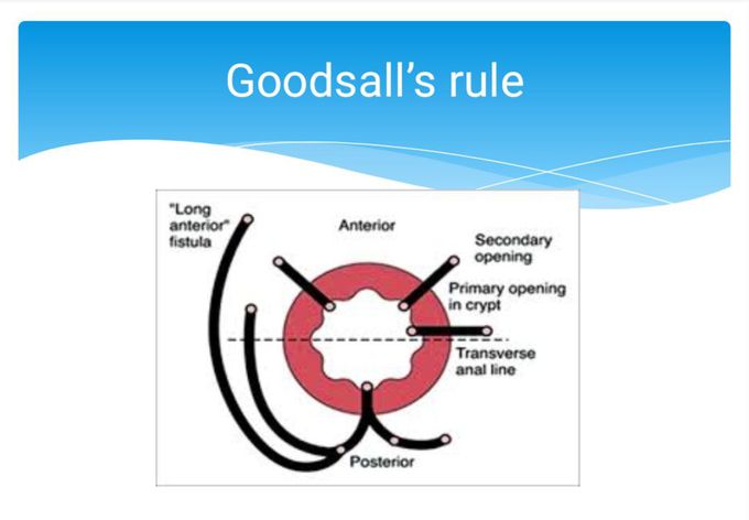 Goodsall's Rule