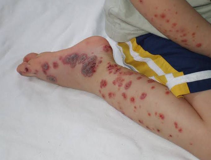 Anaphylactoid Purpura(HSP)