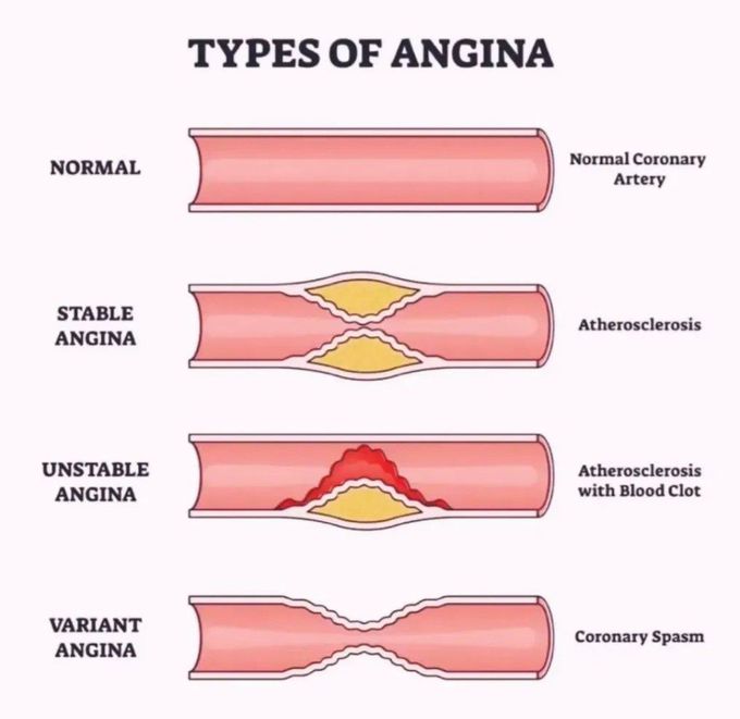 Types of Angina