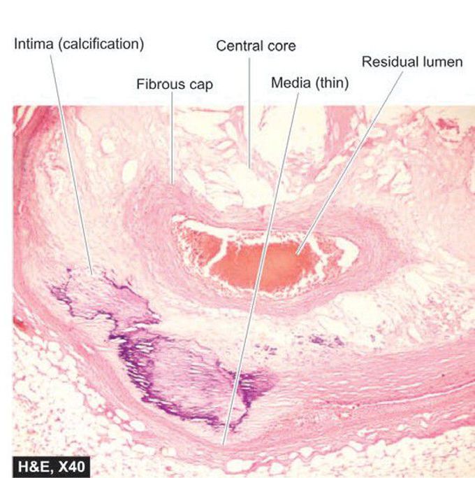 Atheromatous plaque.