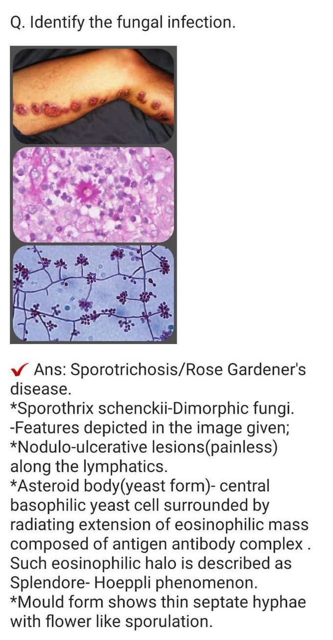 Type of Fungal infection
