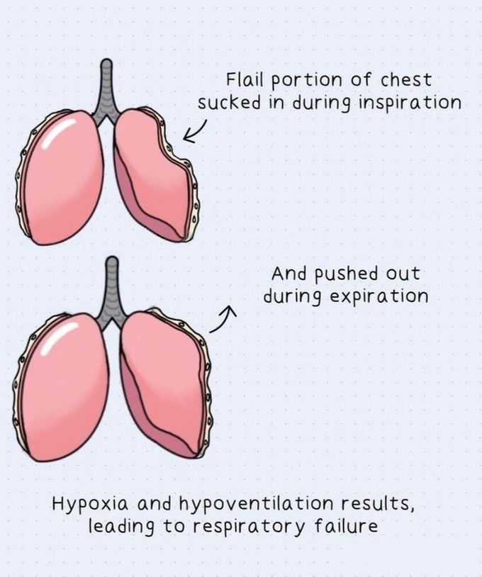 Flail Chest