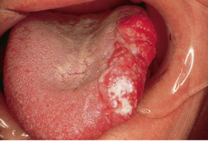 Squamous cell carcinoma of tongue