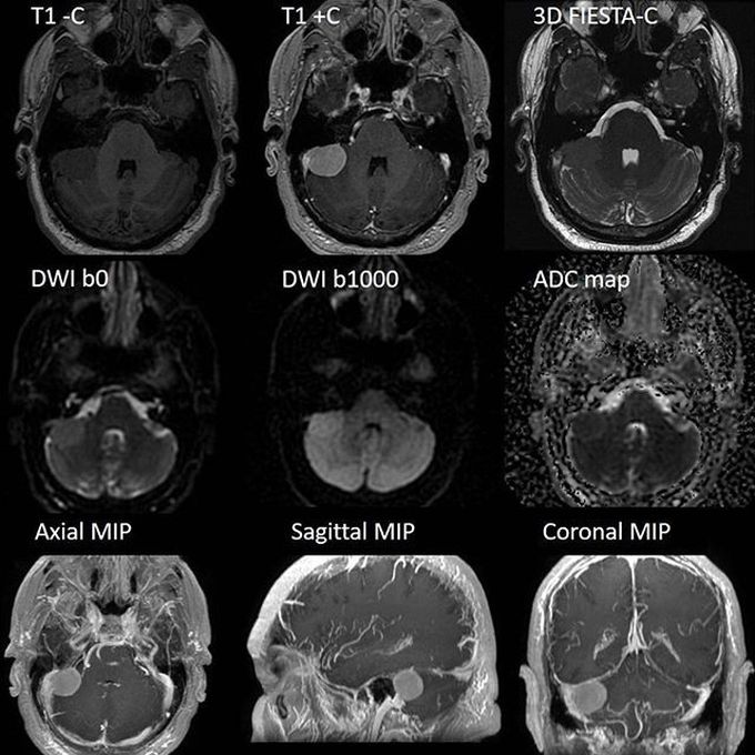 Meningioma MR Imaging