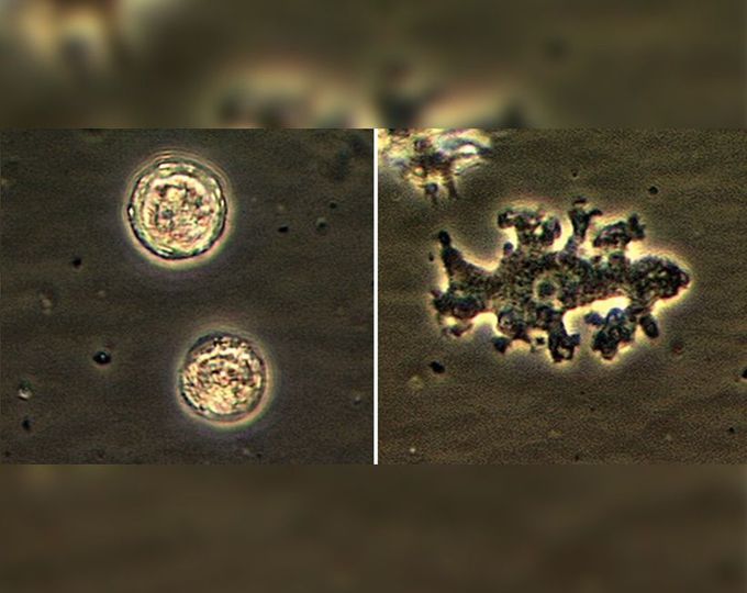🧠 Balamuthia mandrillaris