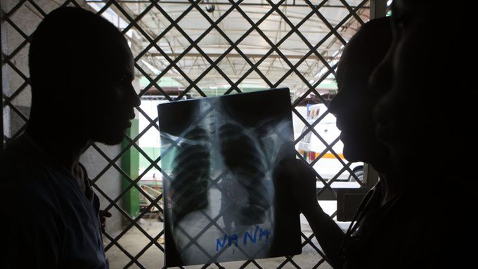Stanford trained AI to diagnose pneumonia better than a radiologist in just two months