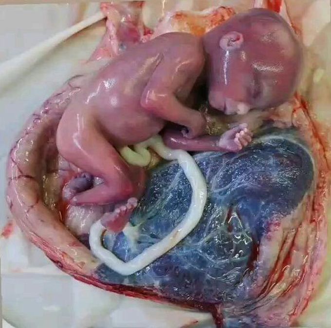 Premature birth