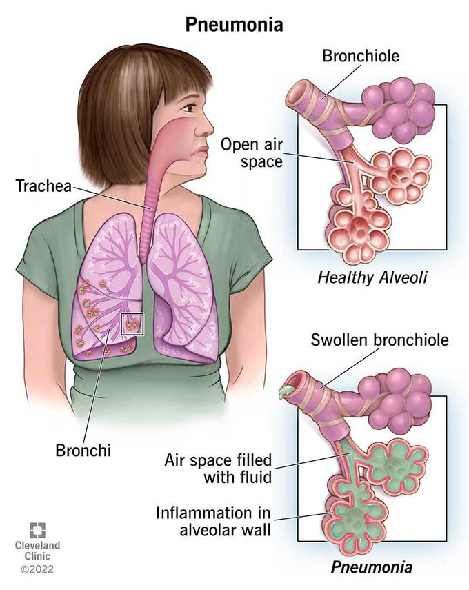 Pneumonia