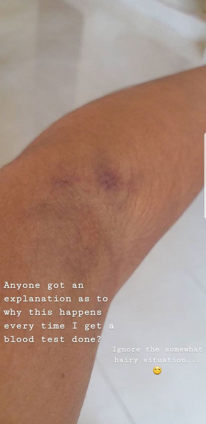 Can someone please explain why this happens Every time I get a blood test done