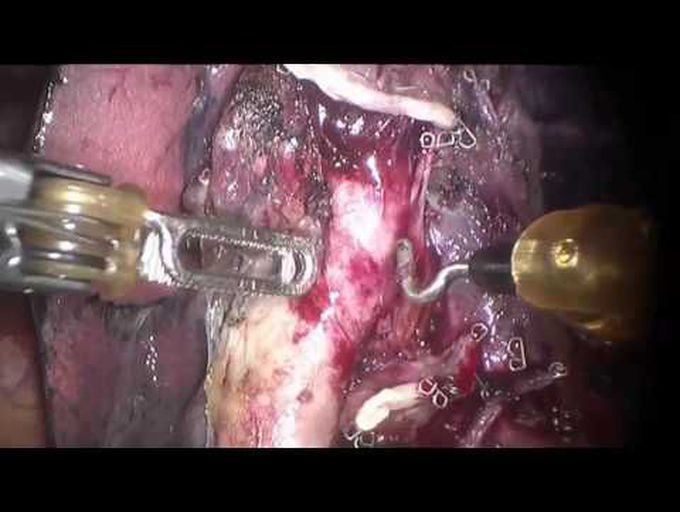 Robot-Assisted Right Middle Lobectomy