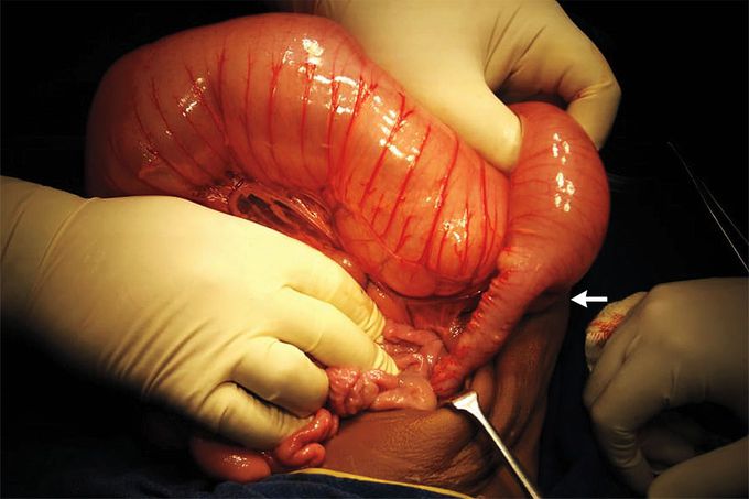 Transition Zone in Hirschsprung’s Disease