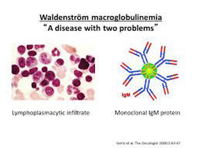 Waldenstorm macroglobulinemia treatment