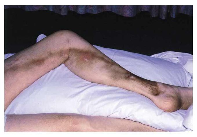 Superficial Thrombophlebitis