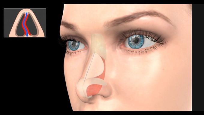 Septoplasty-Animation