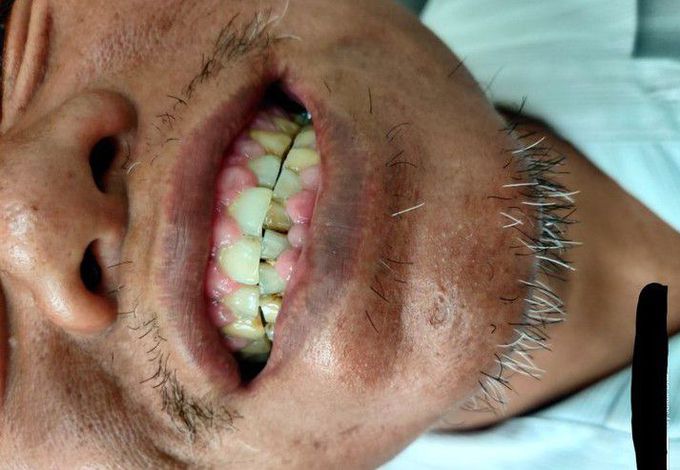 62 years old male known case of T2DM ,under oral hypoglycemic agent since 8 years and newly diagnosed case of HTN who was prescribed Tab. Amlod 10mg once daily by unknown local practitioner, now presents with a chief complain of tachycardia and enlarged gums. No smoker, Occasionally consumes alcohol. The reason I posted this case was that this is a rare example of CCB causing gingival hypertrophy in higher dosages.whats your thought on this???