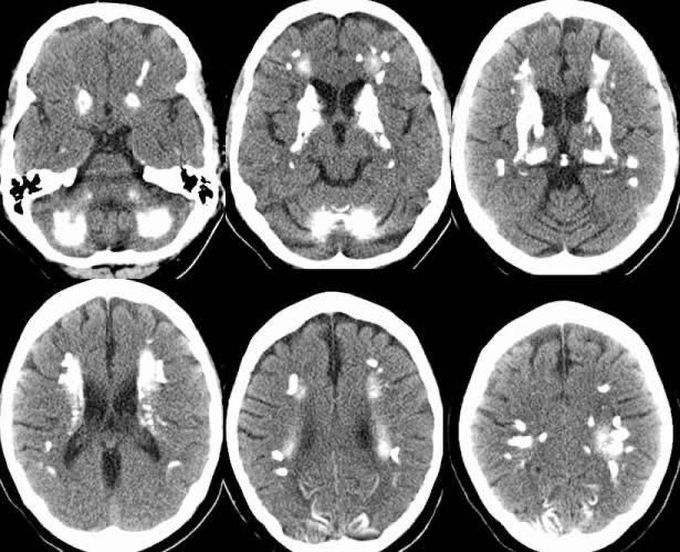 Fahr syndrome symptoms