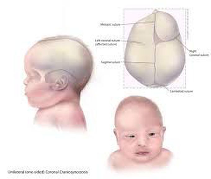 Craniosynostosis