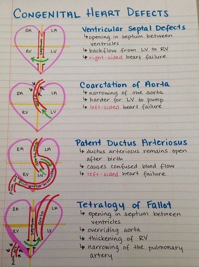 Congenital Heart Defects