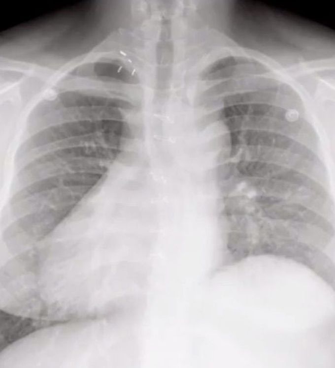 Dextrocardia