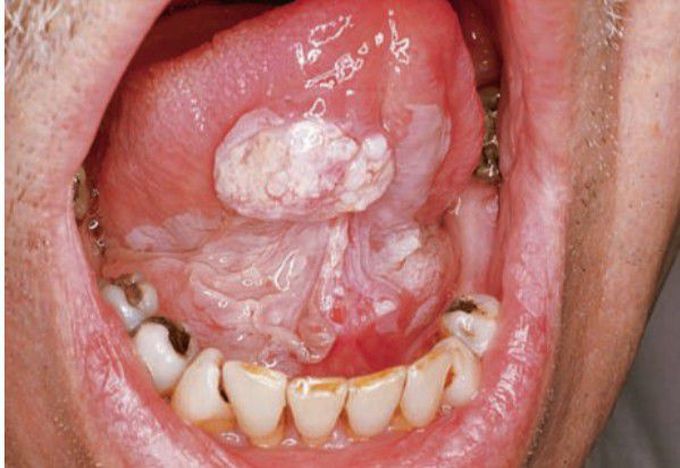 Squamous cell carcinoma of tongue