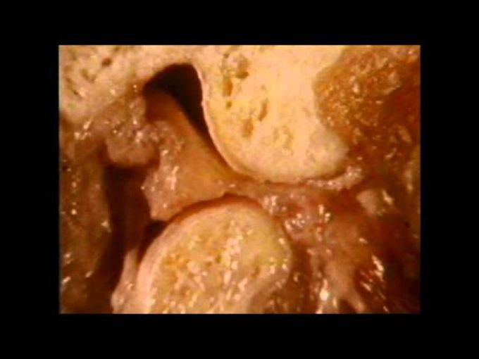Normal Temporomandibular Joint Movement