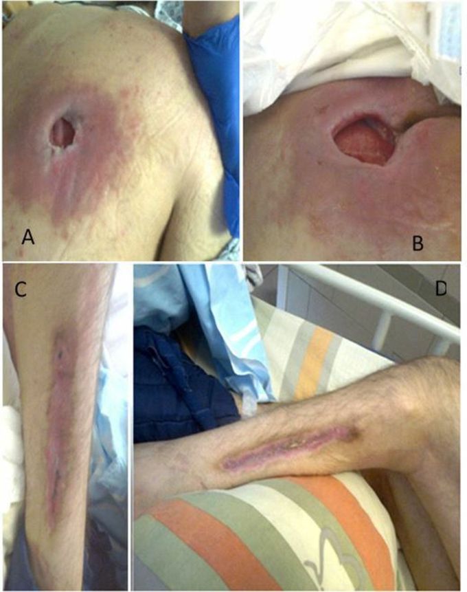 Decubitus Ulcers (Pressure sores)
