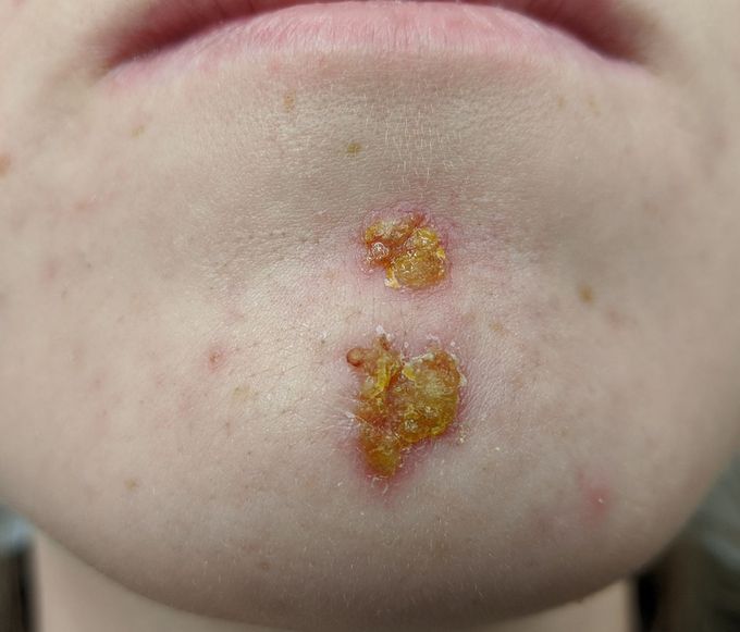 Types and symptoms of impetigo