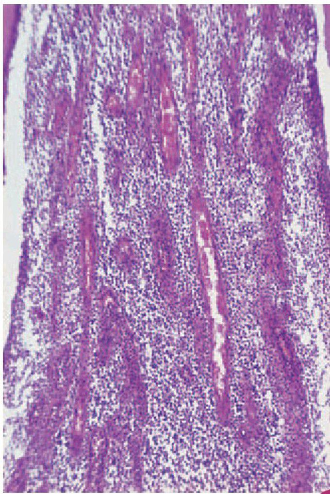 Acute pulpitis – terminal stage.