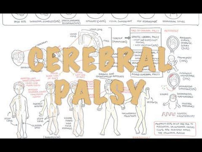 Cerebral Palsy: Overview