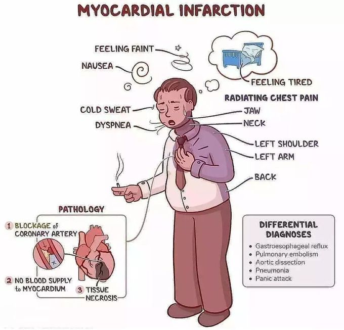 Myocardial Infarction