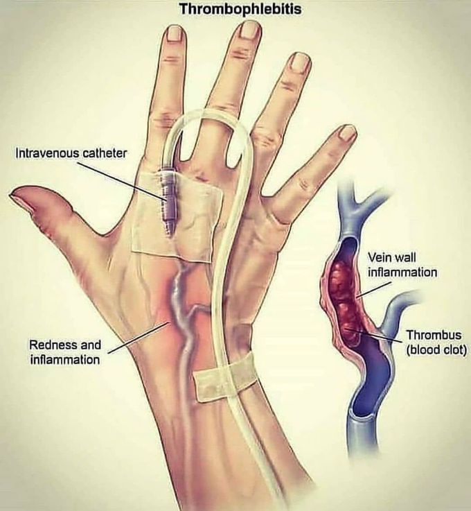Thrombophlebitis