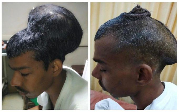 Case Of World's Largest Brain Tumour