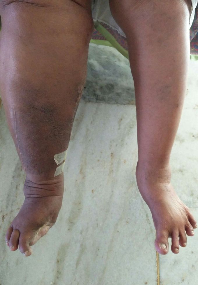 Diabetic foot