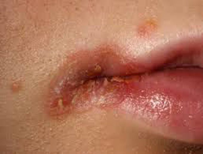 Angular cheilitis