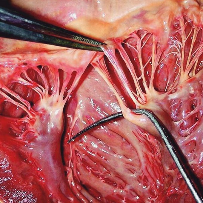 Chordae tendinea and papillary muscle