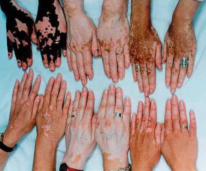 Vitiligo...