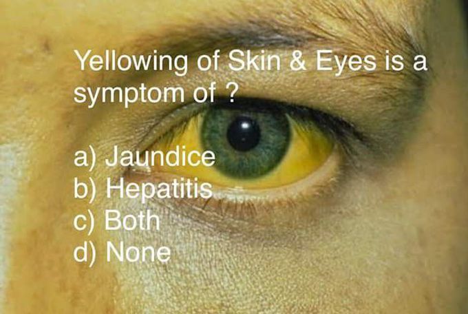 Yellowing of skin and eyes is called?? 
