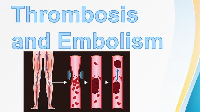 Thrombosis & Embolism | Virchow's triad | Pulmonary Embolism | Types of Embolus | Venous Thrombi