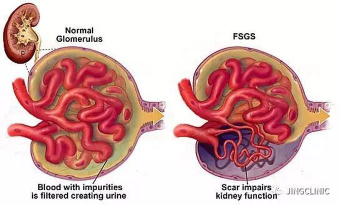 Glomerulosclerosis