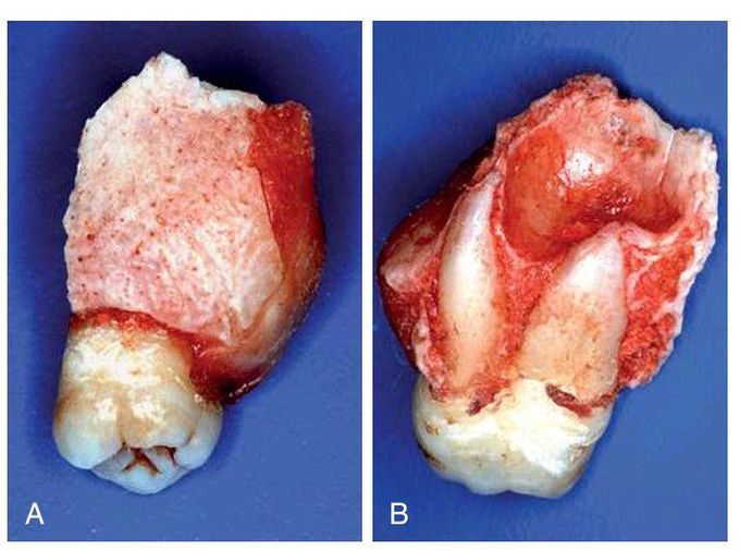 Fracture of maxillary tuberosity