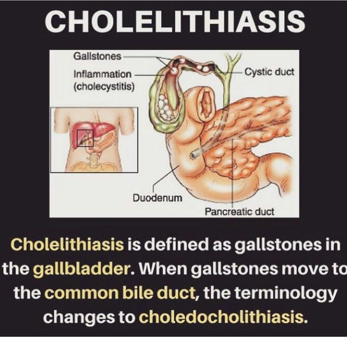 Cholelithasis