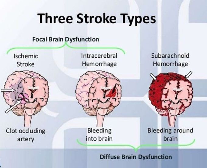 Three Stroke Types