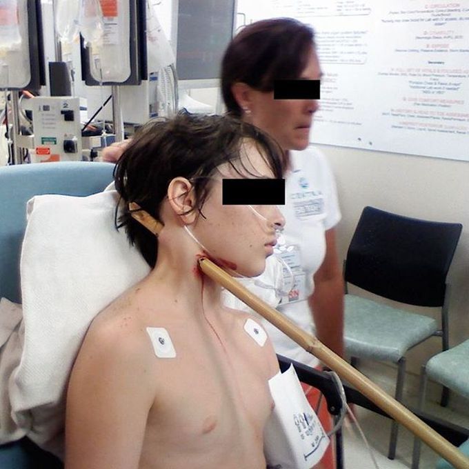 Boy impaled by bamboo through his neck! 