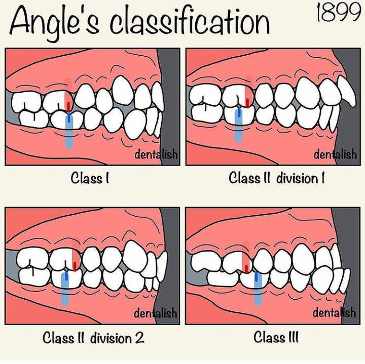 Angle's Classification of Occlusion - MEDizzy